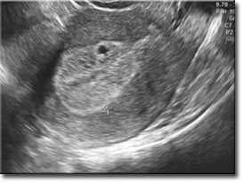 Kanser Rahim kanseri endometriyum kanseri sarkom tedavisi jinekolog tugan beşe kitle